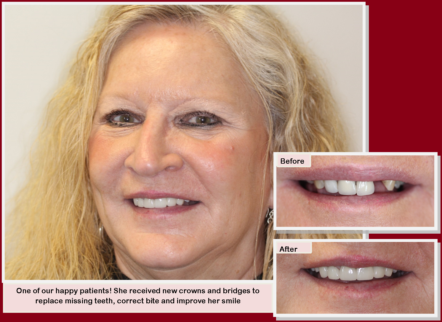 New crowns and bridges to replace missing teeth